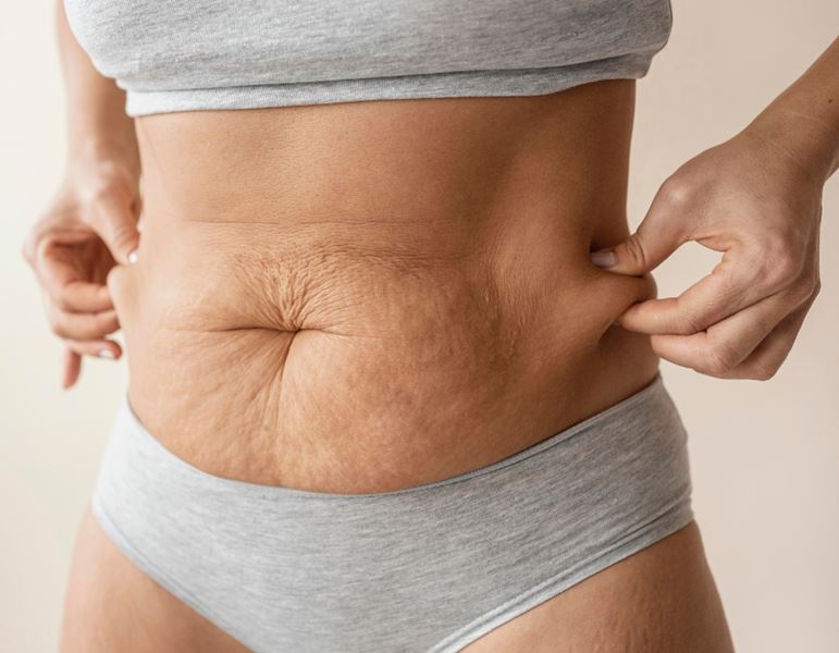 טיפול בסימני מתיחה ע