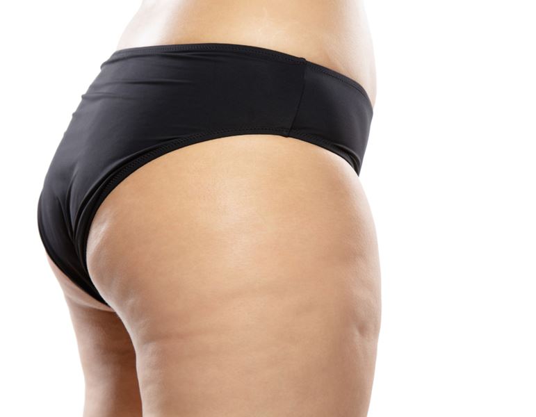 טיפול בצלוליט ע