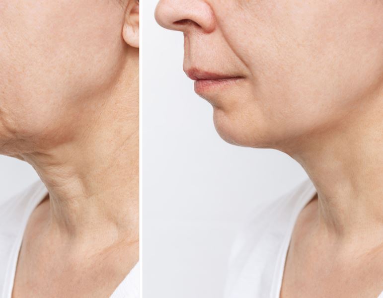 טיפולי פלזמה למתיחת צוואר