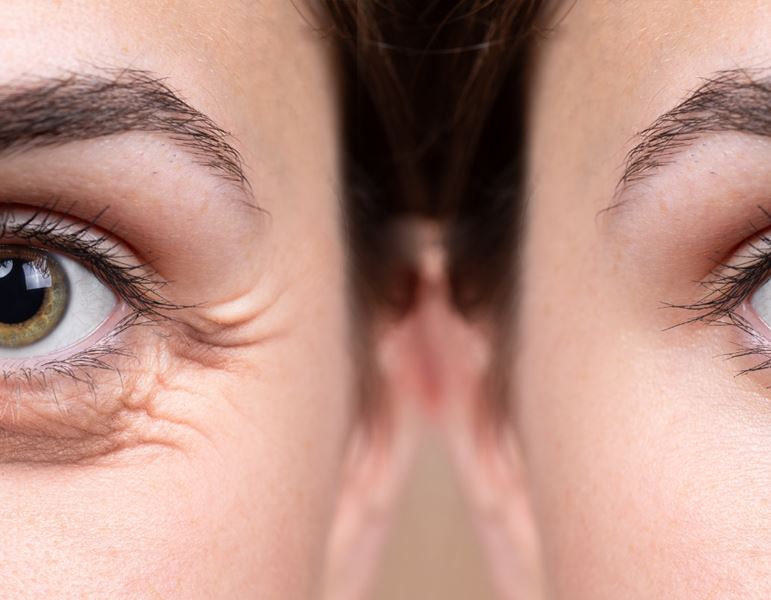 טיפולי פלזמה להרמת עפעפיים